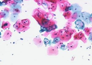 Abnormal PAP Smear Result