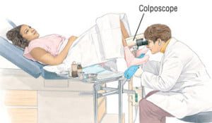 Colposcopy examination