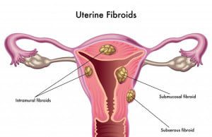 Uterine Fibroids