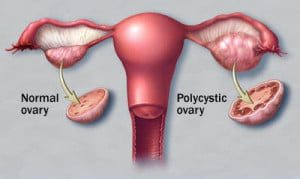 Polycystic Ovary